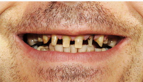 Before — full mouth implant restoration at Downtown Dental