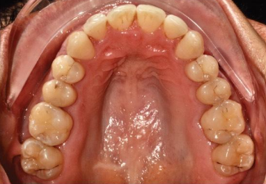After — implant-supported lower arch with stable, natural smile