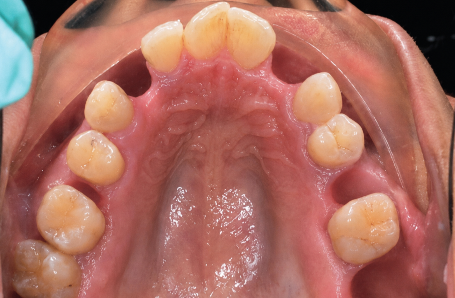 Before — lower arch teeth restored with All-On-X implants at Downtown Dental