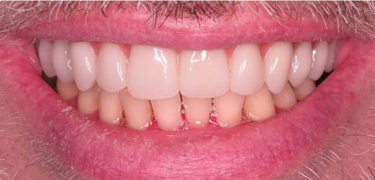 After — fixed, natural-looking upper arch All-On-X smile at Downtown Dental