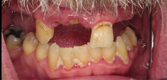 Before — upper arch All-On-X implant restoration at Downtown Dental